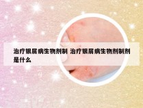 治疗银屑病生物剂制 治疗银屑病生物剂制剂是什么