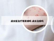 卤水能治疗银屑病吗 卤水治癣吗