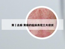 黄栢去癣 黄癣的临床表现三大症状