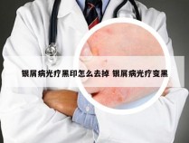 银屑病光疗黑印怎么去掉 银屑病光疗变黑