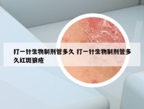 打一针生物制剂管多久 打一针生物制剂管多久红斑狼疮