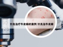 针灸治疗牛皮癣的案例 针灸治牛皮廨