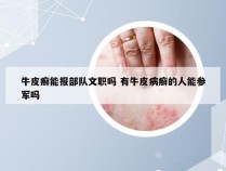 牛皮癣能报部队文职吗 有牛皮病癣的人能参军吗