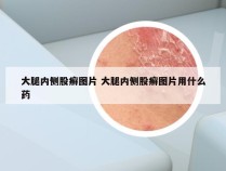 大腿内侧股癣图片 大腿内侧股癣图片用什么药