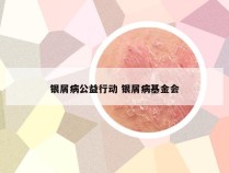 银屑病公益行动 银屑病基金会