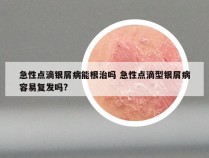 急性点滴银屑病能根治吗 急性点滴型银屑病容易复发吗?