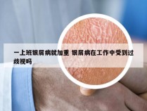 一上班银屑病就加重 银屑病在工作中受到过歧视吗