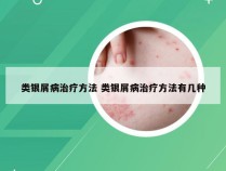 类银屑病治疗方法 类银屑病治疗方法有几种