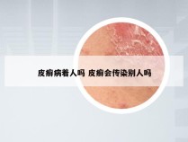 皮癣病着人吗 皮癣会传染别人吗