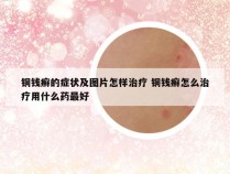 铜钱癣的症状及图片怎样治疗 铜钱癣怎么治疗用什么药最好