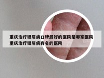 重庆治疗银屑病口碑最好的医院是哪家医院 重庆治疗银屑病有名的医院