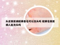 头皮银屑病硫磺香皂可以洗头吗 硫磺皂银屑病人能洗头吗