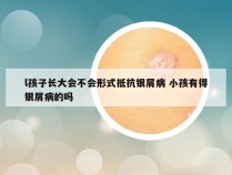 l孩子长大会不会形式抵抗银屑病 小孩有得银屑病的吗