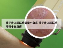 孩子身上起红疙瘩带小白点 孩子身上起红疙瘩带小白点痒