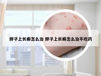 脖子上长癣怎么治 脖子上长癣怎么治不吃药