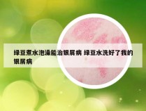 绿豆煮水泡澡能治银屑病 绿豆水洗好了我的银屑病