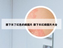 腋下长了红色的癣图片 腋下长红癣图片大全