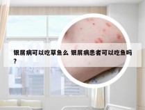 银屑病可以吃草鱼么 银屑病患者可以吃鱼吗?