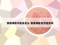 银屑病有可能自愈么 银屑病能自然痊愈吗