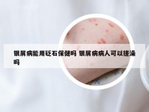 银屑病能用砭石保健吗 银屑病病人可以搓澡吗