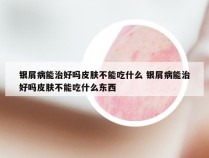 银屑病能治好吗皮肤不能吃什么 银屑病能治好吗皮肤不能吃什么东西