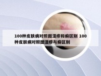 100种皮肤病对照图湿疹和癣区别 100种皮肤病对照图湿疹与癣区别