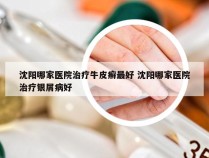 沈阳哪家医院治疗牛皮癣最好 沈阳哪家医院治疗银屑病好