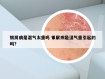 银屑病是湿气太重吗 银屑病是湿气重引起的吗?