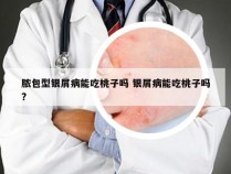 脓包型银屑病能吃桃子吗 银屑病能吃桃子吗?