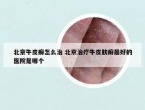 北京牛皮癣怎么治 北京治疗牛皮肤癣最好的医院是哪个