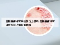 皮肤癣痒净可以往伤口上摸吗 皮肤癣痒净可以往伤口上摸吗有用吗