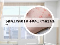 小孩身上长的那个癣 小孩身上长了癣怎么治疗