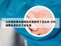 小时候患黄头癣现在头皮掉光了怎么办 小时候黄头发长大了白头发