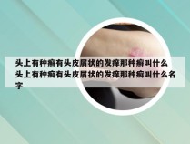 头上有种癣有头皮屑状的发痒那种癣叫什么 头上有种癣有头皮屑状的发痒那种癣叫什么名字