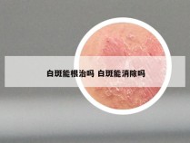 白斑能根治吗 白斑能消除吗