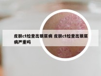 皮肤ct检查出银屑病 皮肤ct检查出银屑病严重吗