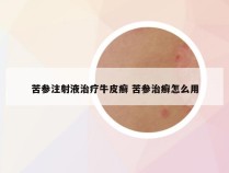 苦参注射液治疗牛皮癣 苦参治癣怎么用