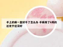 手上的癣一直好不了怎么办 手癣用了6周的达克宁还没好