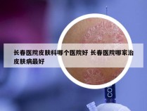 长春医院皮肤科哪个医院好 长春医院哪家治皮肤病最好