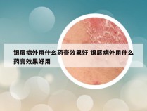 银屑病外用什么药膏效果好 银屑病外用什么药膏效果好用