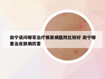 南宁请问哪家治疗银屑病医院比较好 南宁哪里治皮肤病厉害