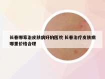 长春哪家治皮肤病好的医院 长春治疗皮肤病哪里价格合理