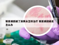 银屑病抓破了淌黄水怎样治疗 银屑病挠破皮怎么办