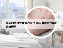 腿上的癣用什么偏方治疗 腿上长癣用什么药膏好得快