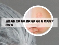 后背两侧皮肤有癣屑前胸两侧也有 前胸后背起皮癣