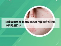 轻度白癞风图 轻度白癞风图片能治疗吗北京中科专病门诊