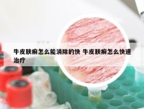 牛皮肤癣怎么能消除的快 牛皮肤癣怎么快速治疗