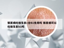 银屑病吃维生素c合B1有用吗 银屑病可以吃维生素b1吗