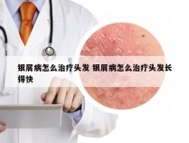 银屑病怎么治疗头发 银屑病怎么治疗头发长得快