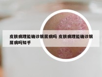 皮肤病理能确诊银屑病吗 皮肤病理能确诊银屑病吗知乎